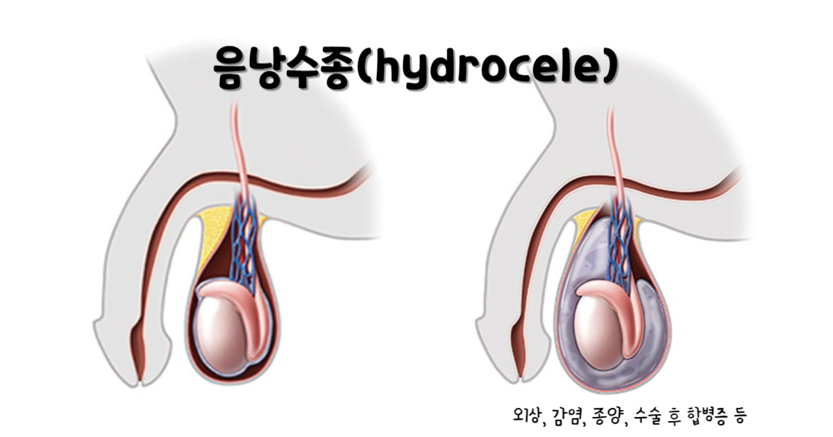 음낭수종
음낭수종의 원인 : 외상, 감염, 종양, 수술 후 합병증 등