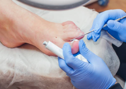 내성발톱 자가치료 교정기 내성발톱 수술 테이프 제품 추천