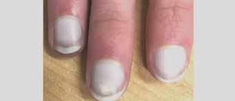 손톱 색깔로 보는 건강