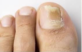 2026 발톱무좀 완치 루틴 공개|약보다 중요한 4단계 관리법