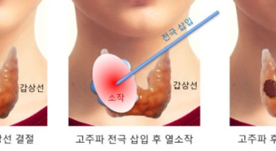 갑상선 이미지