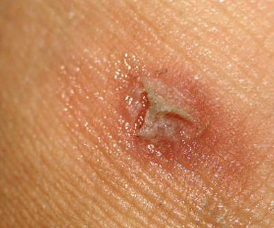 티눈 없애는 방법