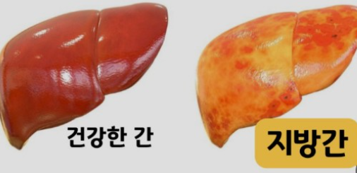 간 수치 검사의 정상 범위와 낮거나 높으면 그 의미와 증상
