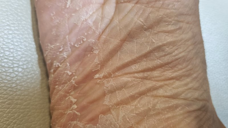 발뒤꿈치 각질 탈락