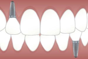 오산시-임플란트-치과-가격-비용-싼-곳,저렴한-곳,잘하는-곳,유명한-곳-BEST20-추천3