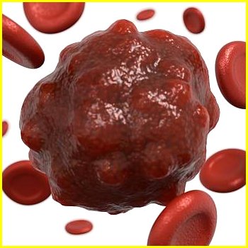 육종암 증상 및 원인 예방법 놓치면 후회할 생존 꿀팁 총정리