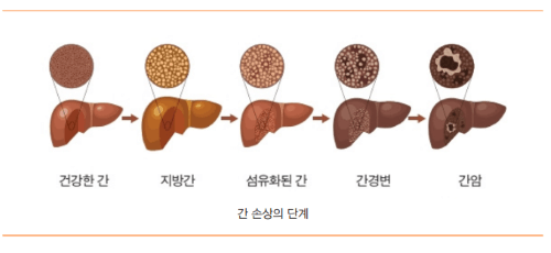 간암도 완치가 있나요?(세브란스 김도영 교수 1문 1답)