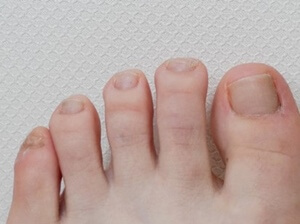 내향성 발톱 내성발톱 병원 교정기 밴드 치료 수술 테이프