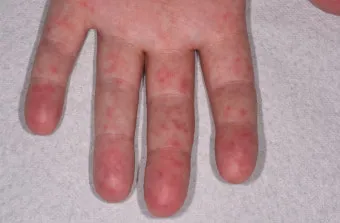 수족구 초기 증상 어른 감염 격리기간 예방 치료 완전 가이드_7