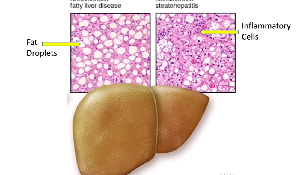 지방간 없애는 방법