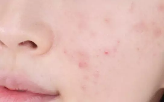 대상포진-초기증상-원인-건강