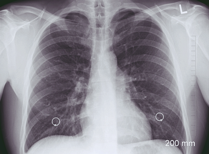 폐포 미세 결석증, 폐 속에 돌이 생기는 희귀 질환