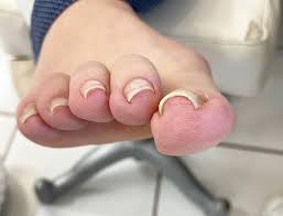 내성발톱 자가치료