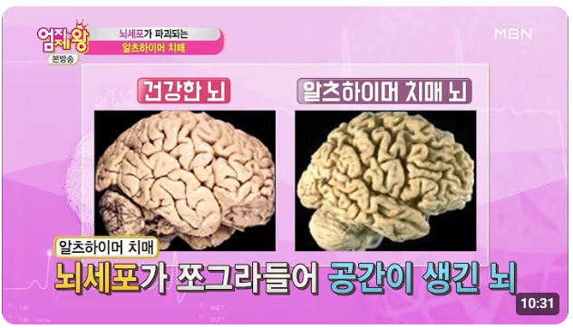 건강한뇌와 알츠하이머치매뇌