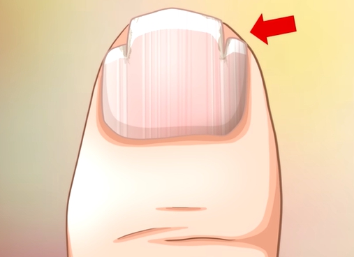 손톱에 세로줄이 생기는 이유