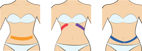 복부 군살 제거