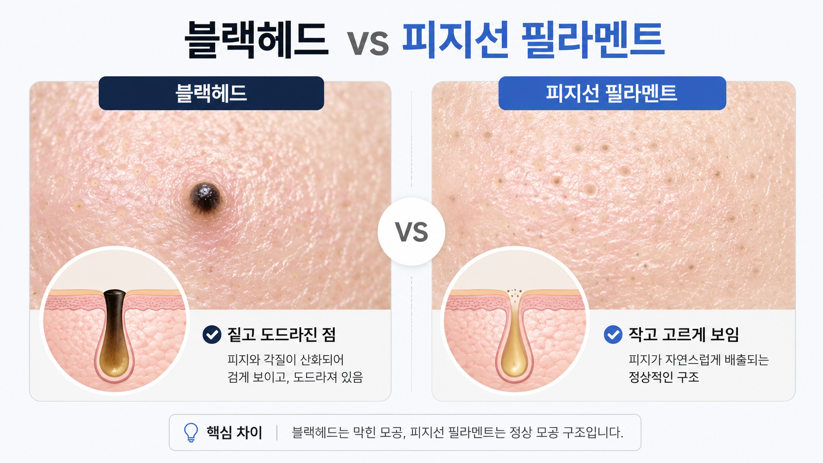 블랙헤드와 피지선 필라멘트의 모양과 구조 차이를 비교한 이미지