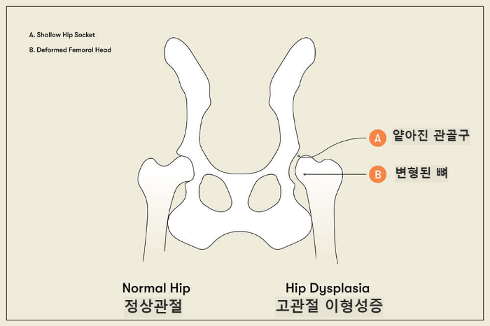 고관절 이형성증