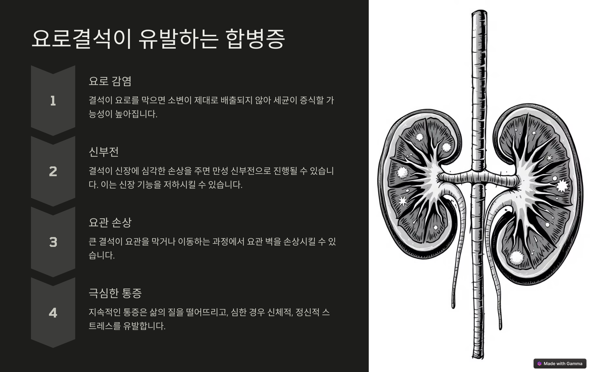 요로결석 원인, 증상, 시술 제거와 요로결석에 좋은 음식