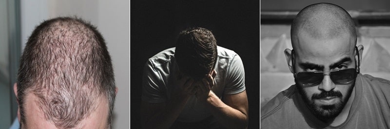 남성 모발 건강과 비오틴 섭취