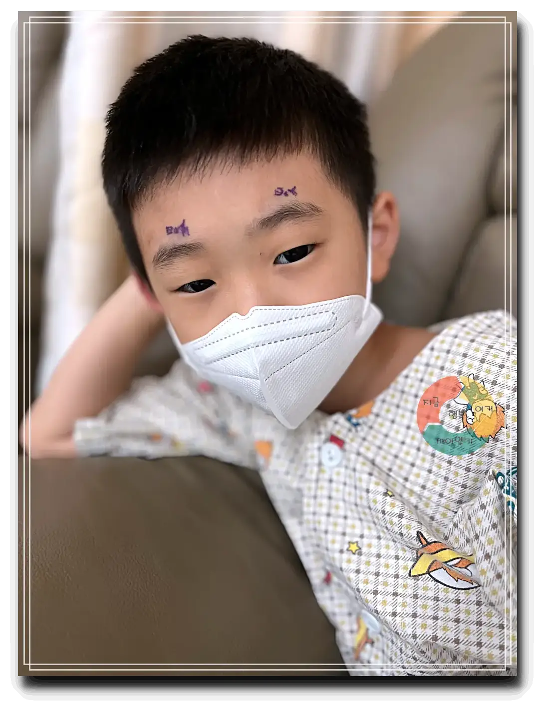 안검내반_양쪽- 눈썹-위-수술부위-표시