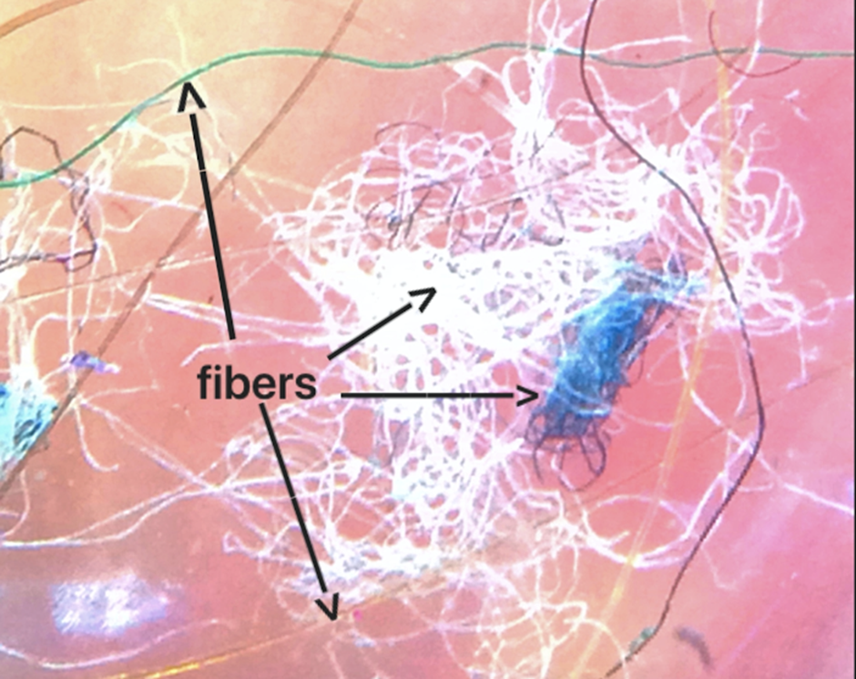 모르젤론병 환자의 피부