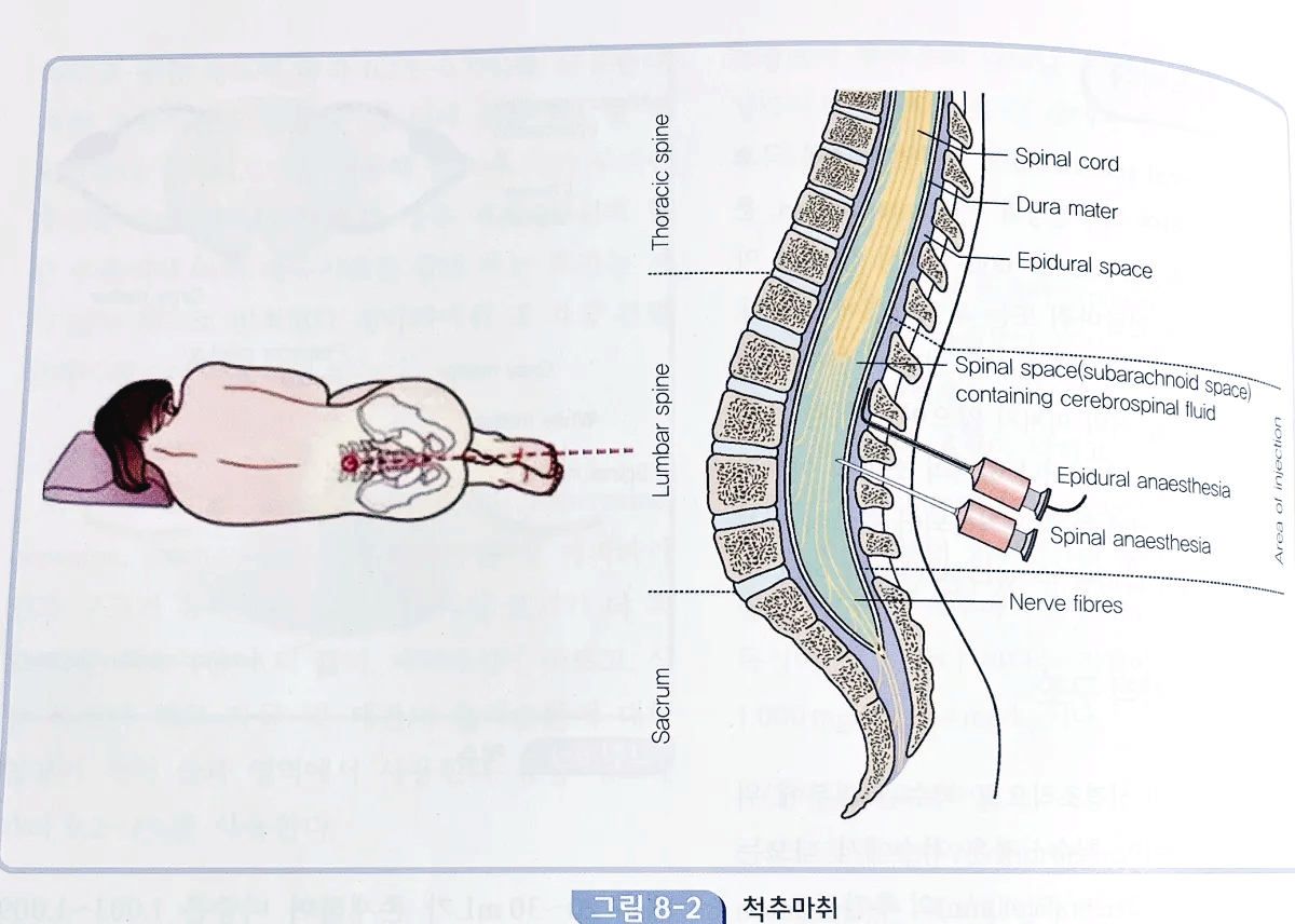 척추마취 방법