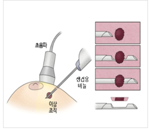 맘모톰 수술이란