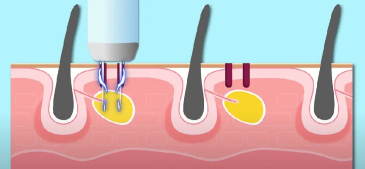 아그네스-레이저-치료중인-피부
