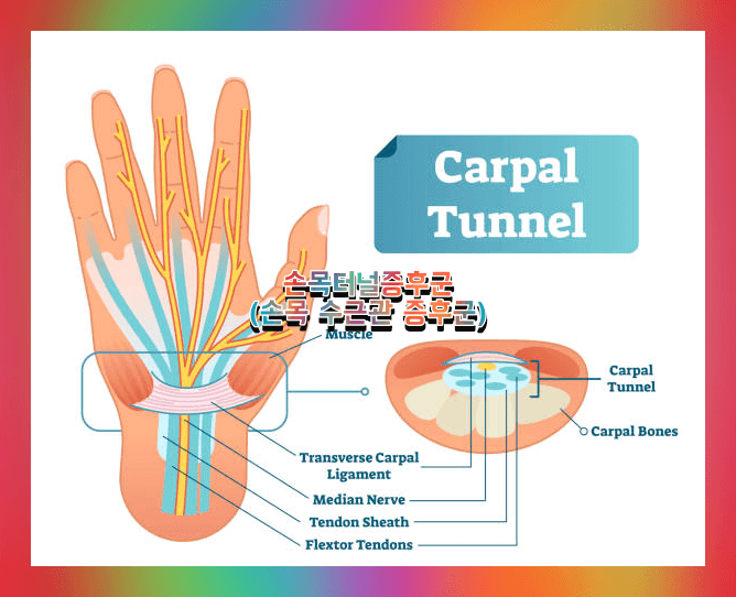 손목 터널 증후군