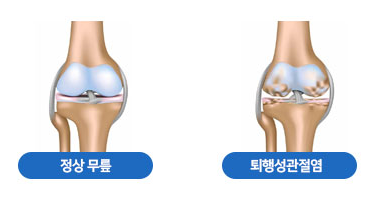 정상관절과 퇴행성관절염 사진