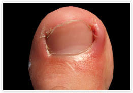 내성발톱 자가치료