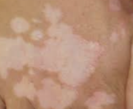 백반증 초기증상 3