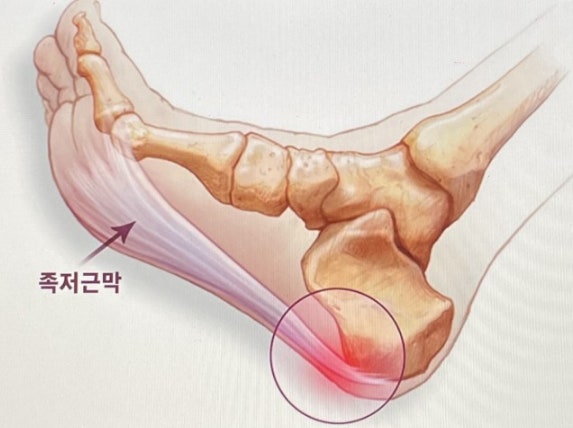 족저근막염의 모습