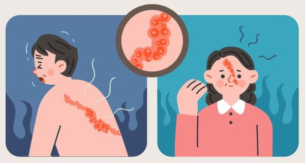 대상포진 일러스트 이미지 1