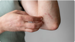 콜린성 두드러기 증상 치료