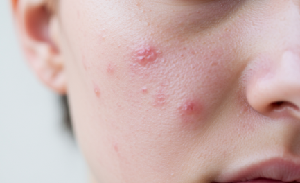 과다 섭취 시 여드름 발생