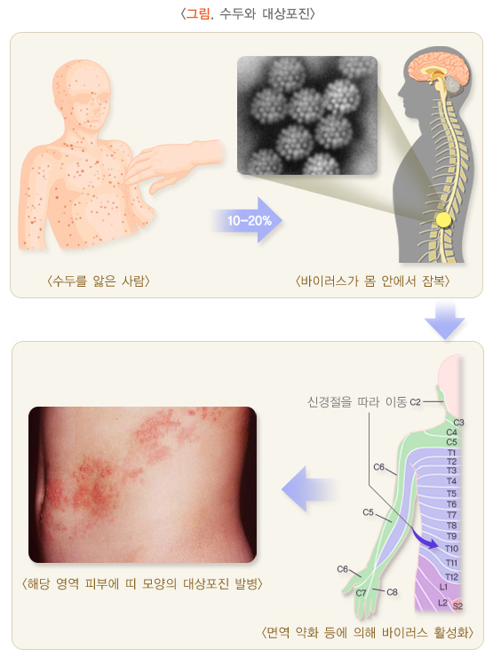 수두와 대상포진