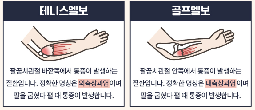 팔꿈치 통증 1