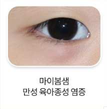 다래끼3