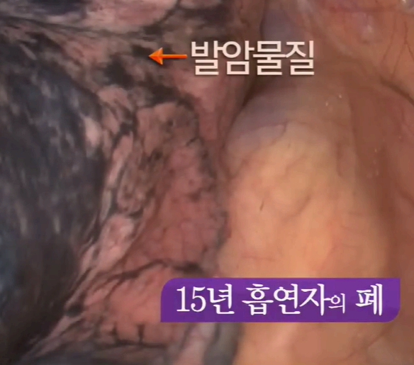 15년 흡연자의 폐