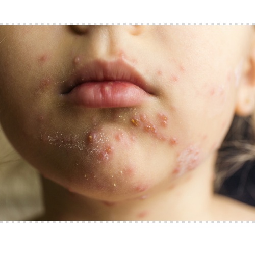 구안와사 원인 초기증상, 증상