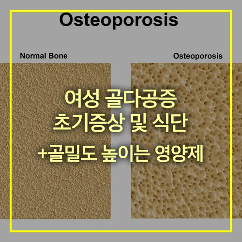 여성 골다공증 초기증상 골밀도 높이는 영양제