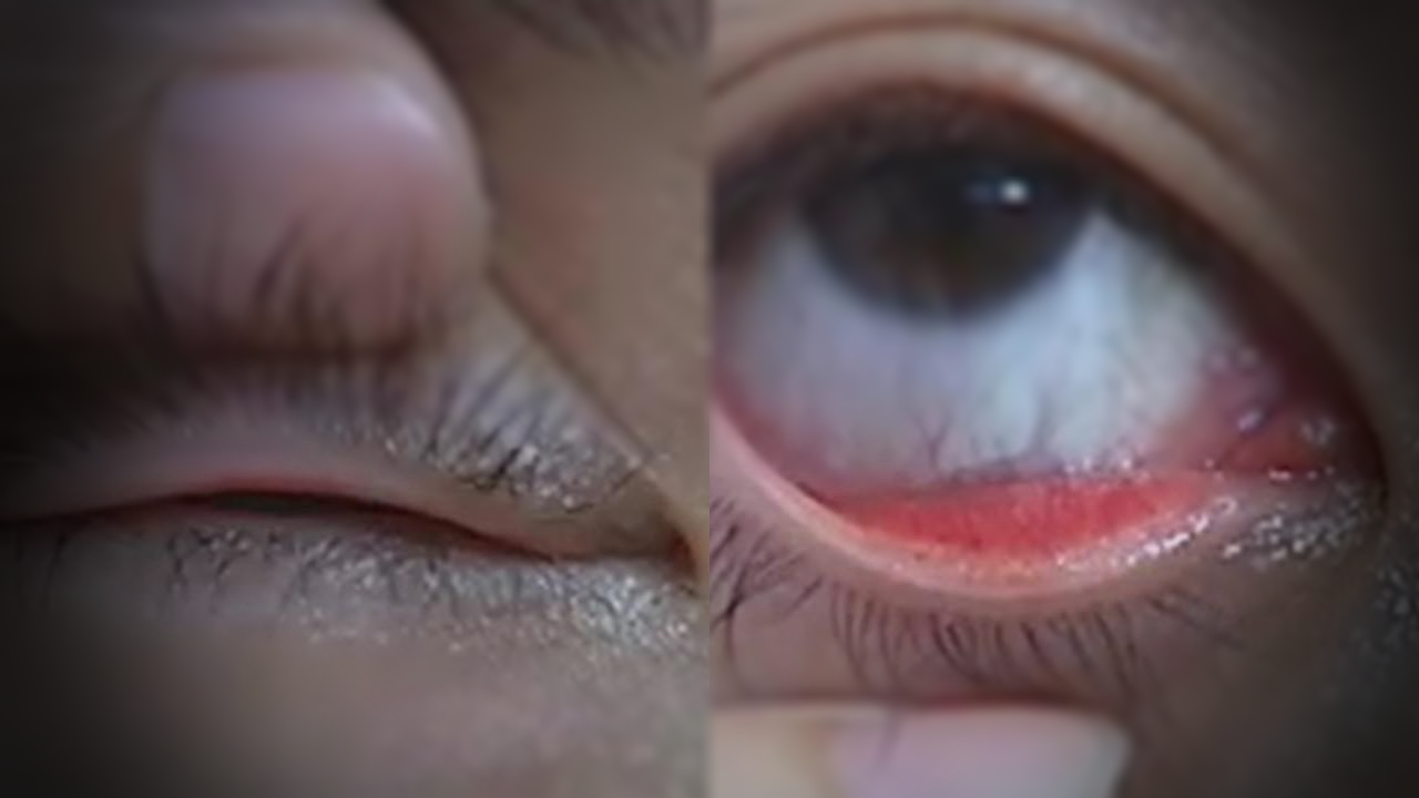 눈커플 뒤집기 사진