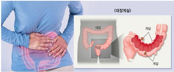 대장게실염재발-배를만지고있는사진과 대장의 내부사진