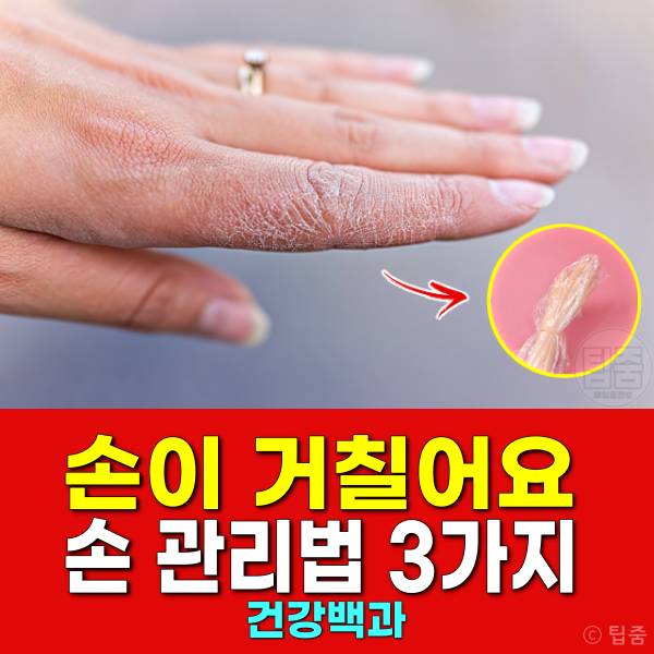 거칠어진 손 관리법 손이거칠어요 손가락 끝 갈라짐 손보들보들
