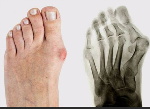발가락 통증