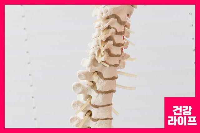 가장 흔한 초기 증상은 허리, 엉덩이 부위 또는 두 부위 모두 통증