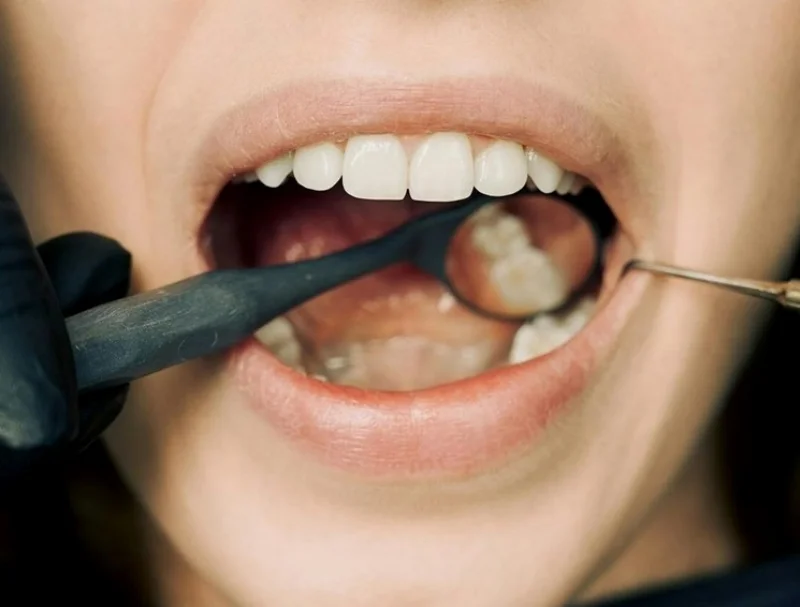 치과 스케일링 비급여