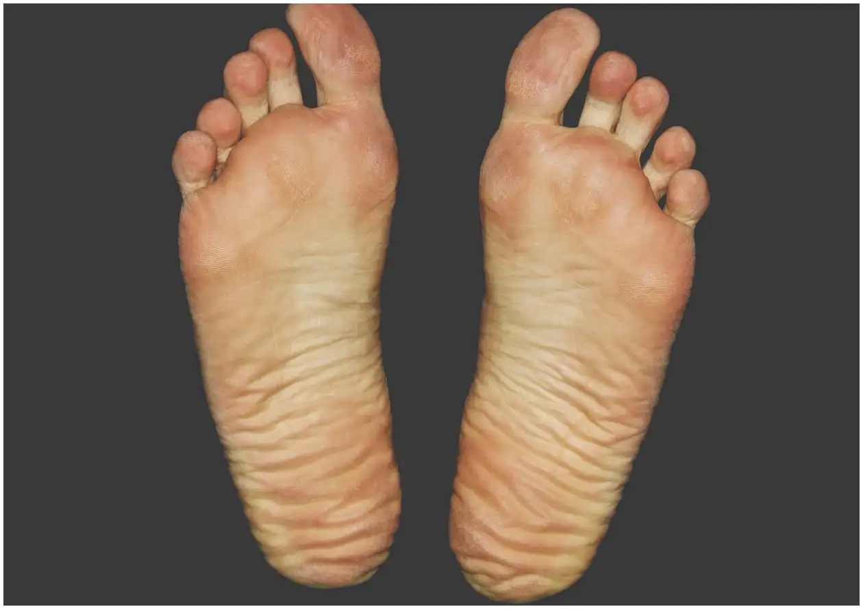 족저 근막염 치료법 (주사, 약, 걷기 중단 방법 등)